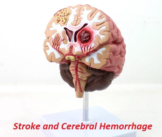  Stroke and Cerebral Hemorrhage Photo